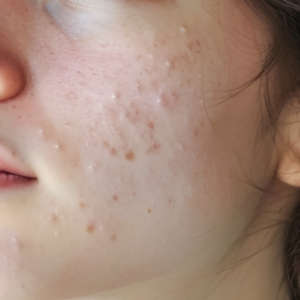 Close-up showing the depth of acne scars on the cheek, representing skin concerns that originate in the deeper dermis layer.