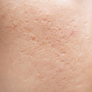 Close-up of skin texture showing atrophic acne scarring, characterized by small, indented pits or depressions on the cheek.