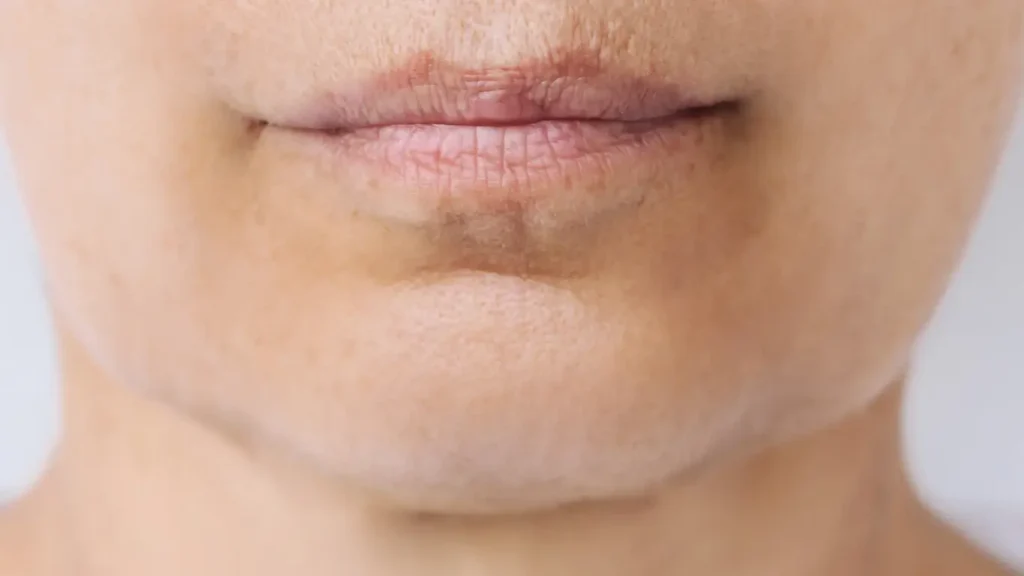 deep chin crease melbourne