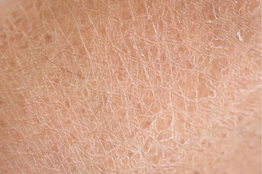 Extreme macro view of dehydrated human skin showing a flaky, cross-hatched texture and fine surface lines.