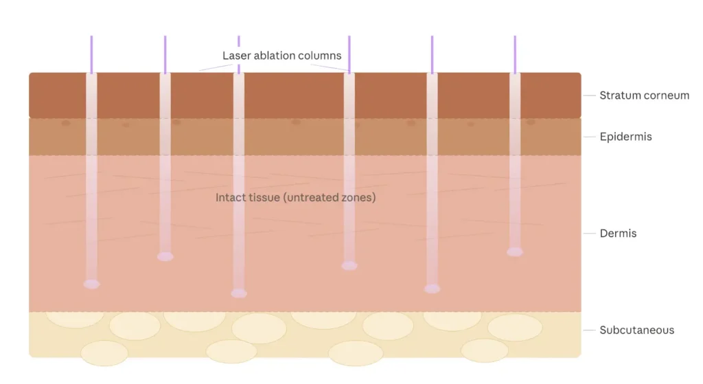 Cross-section diagram of the skin's epidermis and dermis layers being reached by fractional laser beams, demonstrating how energy is delivered below the surface.
