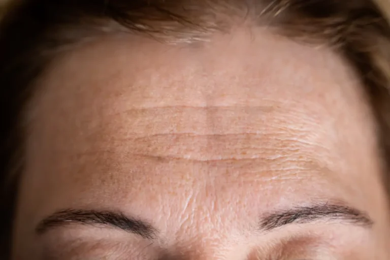 Close-up of forehead lines and wrinkles showing skin concerns and how to prevent forehead wrinkles with proper care