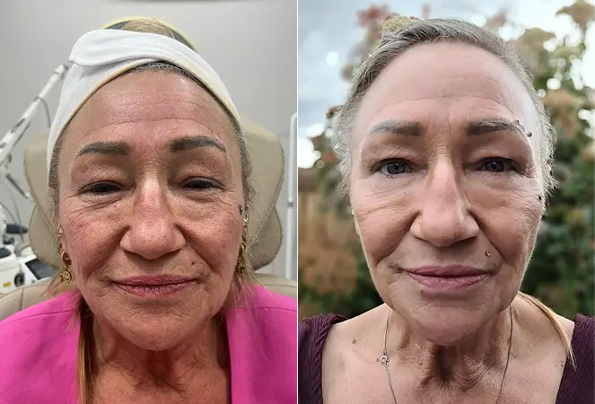 Before and after photos of woman showing how to prevent forehead wrinkles with smoother skin and reduced lines