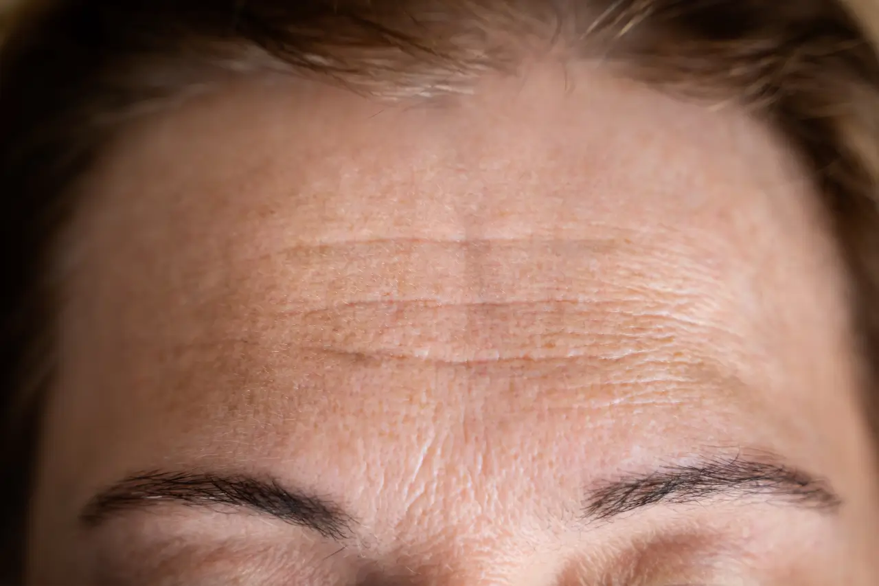Close-up of forehead lines and wrinkles showing skin concerns and how to prevent forehead wrinkles with proper care