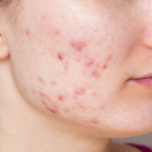 A close-up view of hypertrophic scarring on the face, appearing as raised, thickened areas of skin tissue.