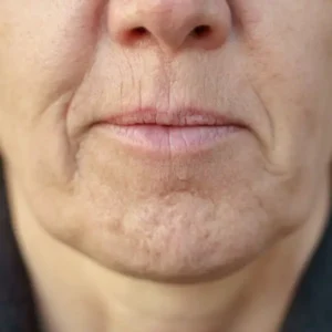 orange peel chin melbourne collagen and skin laxity