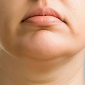 orange peel chin melbourne fat pad changes