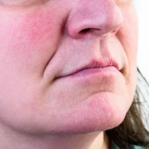orange peel chin melbourne muscle activity