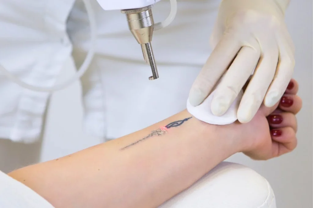 A clinical laser technician performing a PicoSure laser treatment on a forearm tattoo to demonstrate the precision of the picosecond pulses.
