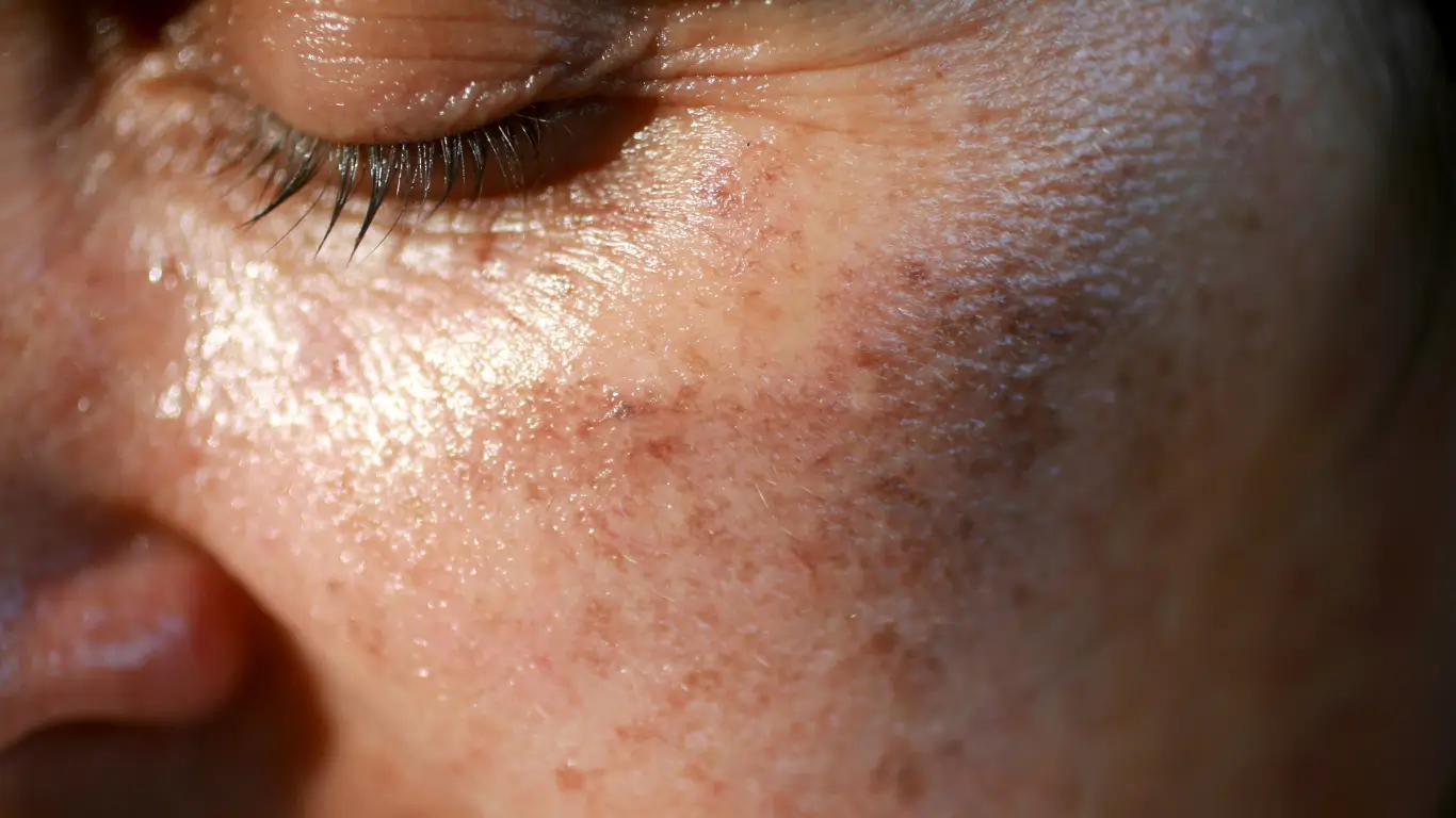skin-pigmentation-melbourne