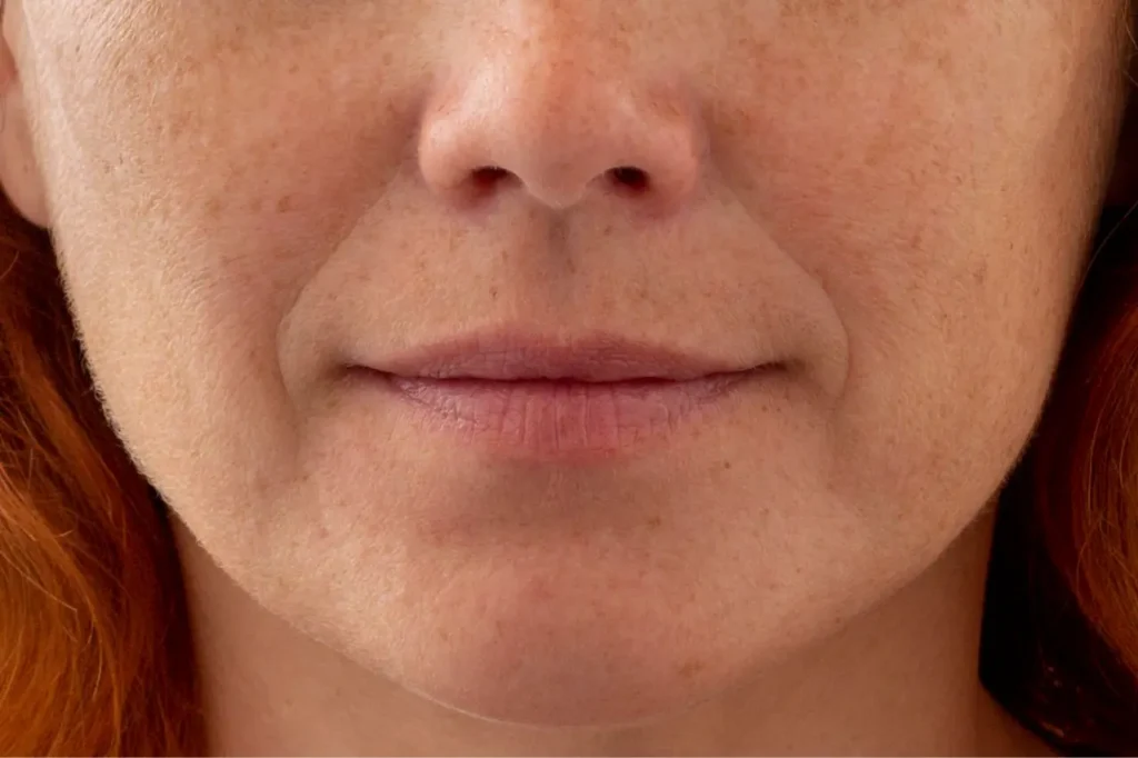 Frontal view of a woman’s lower face showing natural smile lines and nasolabial folds extending from the nose to the corners of the mouth.