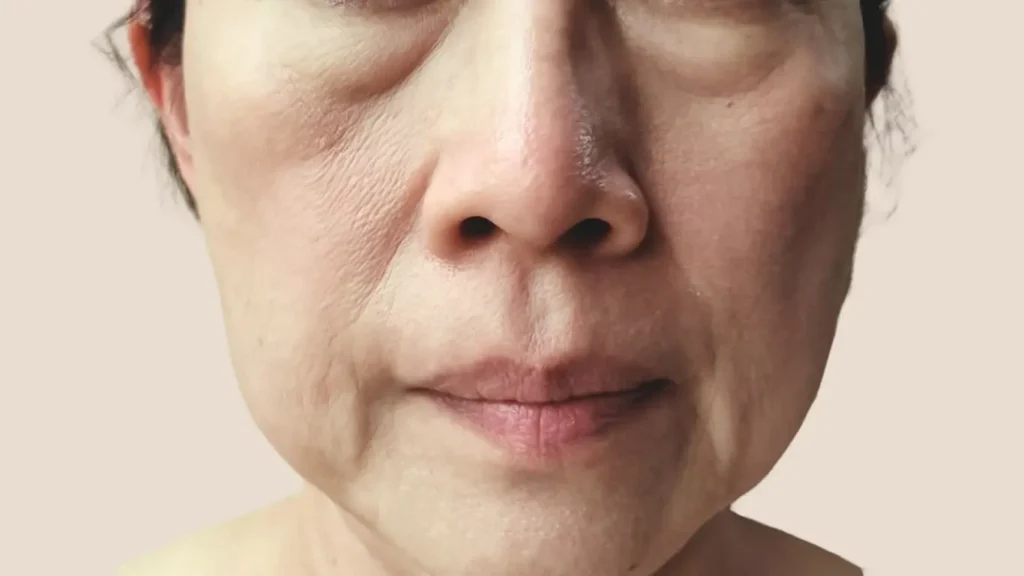 Cheek volume loss melbourne