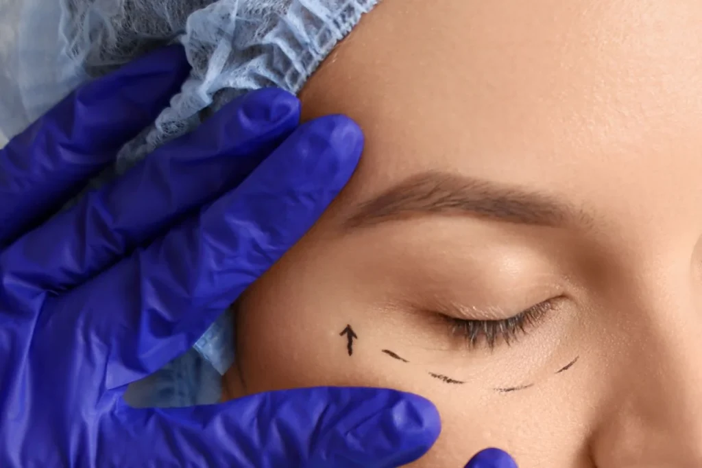 Practitioner marking the eye area with a directional arrow to plan a fox eye thread lift