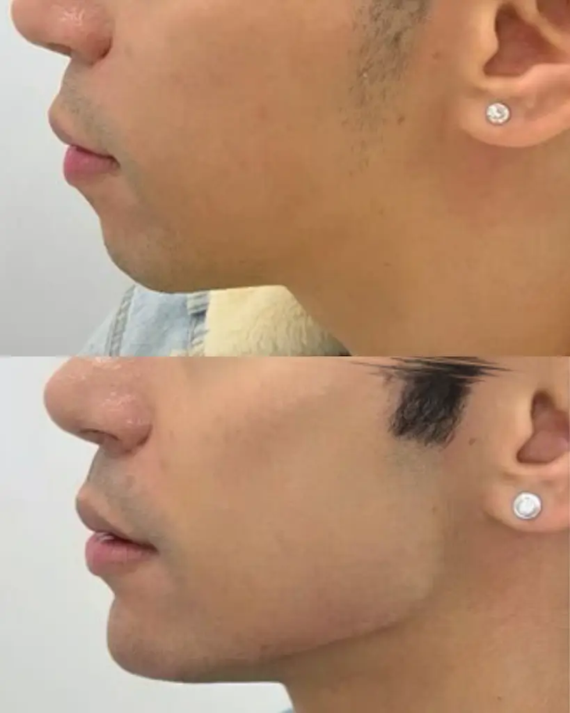 A man's jawline and chin in profile, shown at two stages of his treatment journey