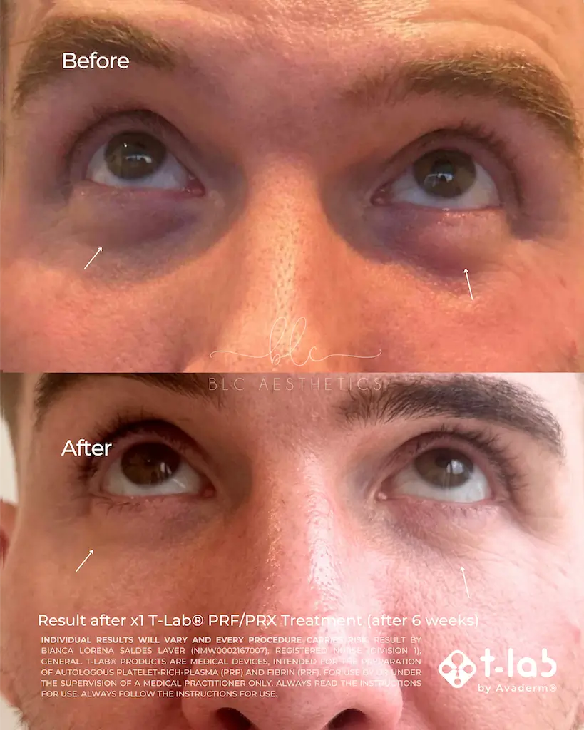 A man's under-eye area shown at two stages of his treatment journey