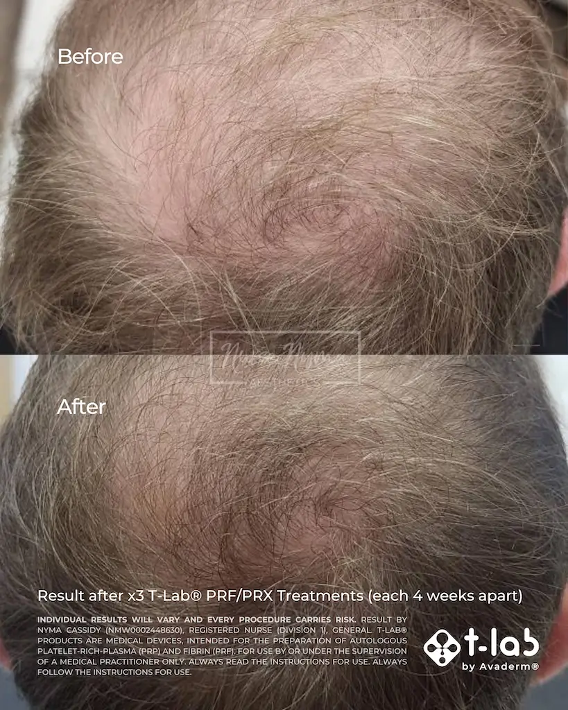 A man's crown and scalp at two stages of his hair thinning treatment journey