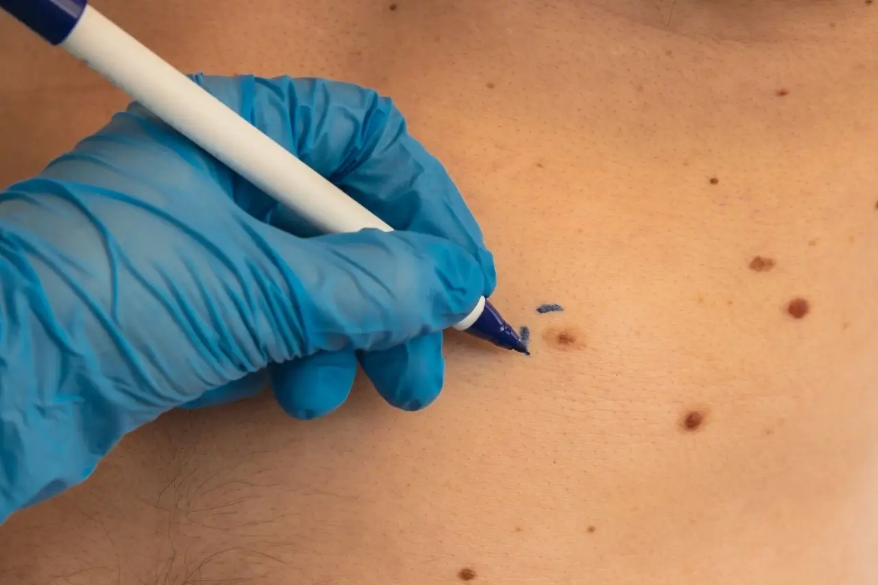 Gloved clinician marking a pigmented spot on the skin for assessment