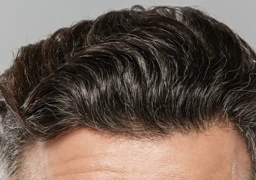 Man's hairline and greying temples, a common men's hair thinning concern