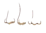 Nose asymmetry illustration showing differences in nasal shape and alignment