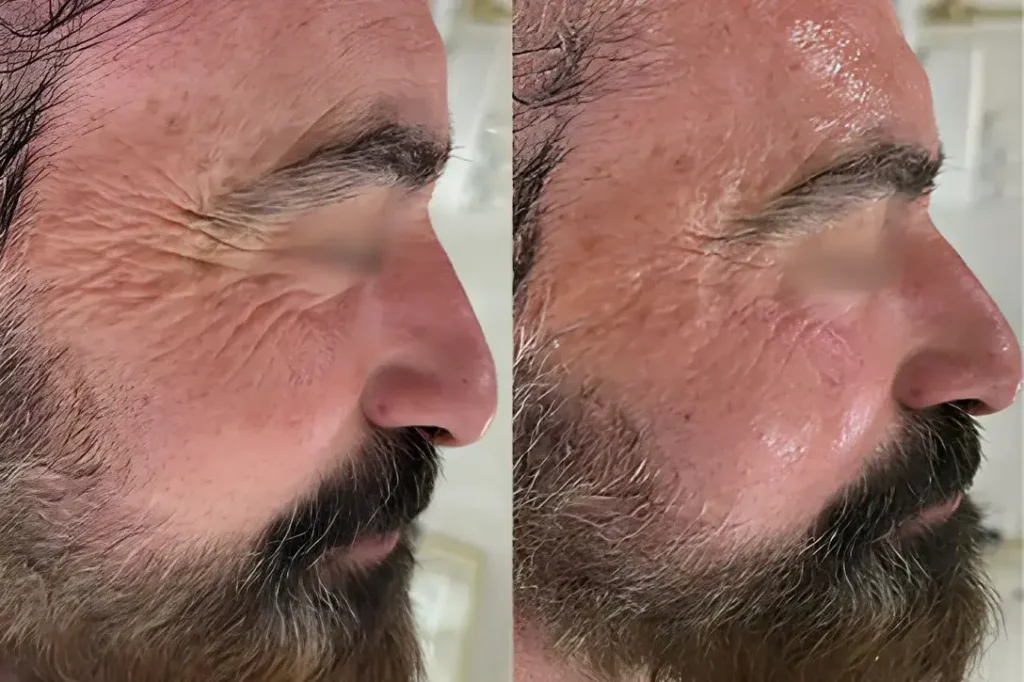 Cosmetic procedure results on a man, before and after side profile showing reduced wrinkles and expression lines