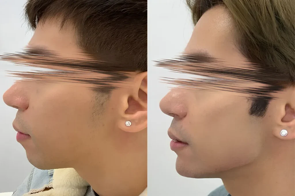 Before and after side profile of a man showing improved jawline definition from cosmetic treatment