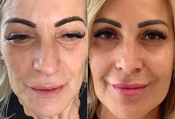 BeforeAndAfterNewSetB-1