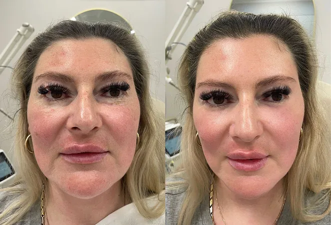 Patient before and after comparison showing rejuvenated skin following laser skin treatment in Melbourne