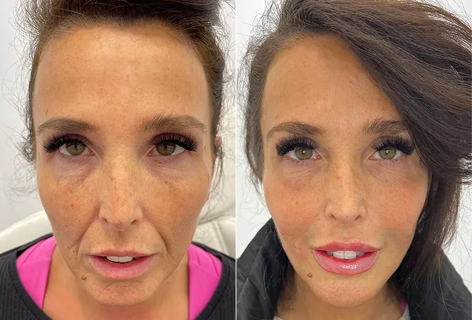 BeforeAndAfterSetNewE-1