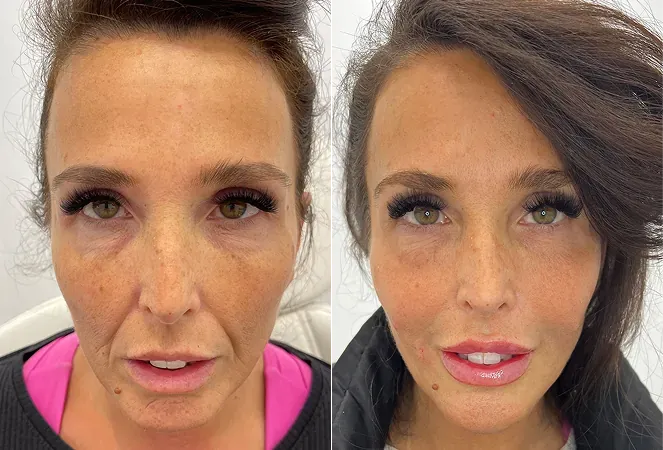 Two-panel before and after comparison showing a front-facing view of a woman's face