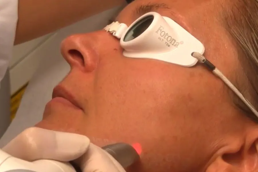 Fotona SupErficial mode treating the cheek in profile during a Fotona 5D session, patient positioned side-on