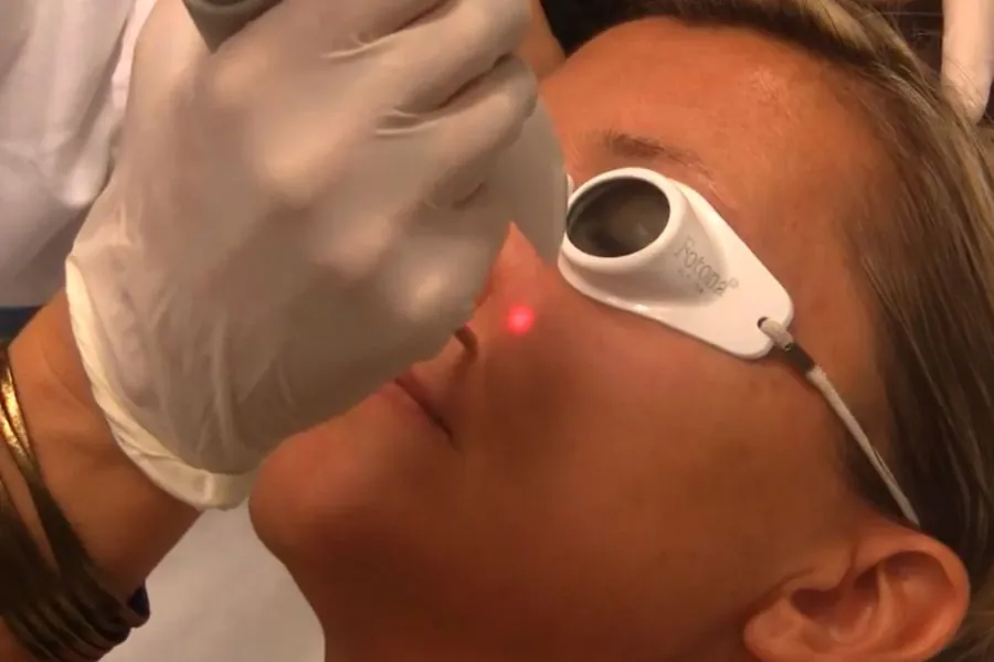 FRAC3 laser handpiece treating the cheek during a Fotona 5D session, with protective eyewear in place