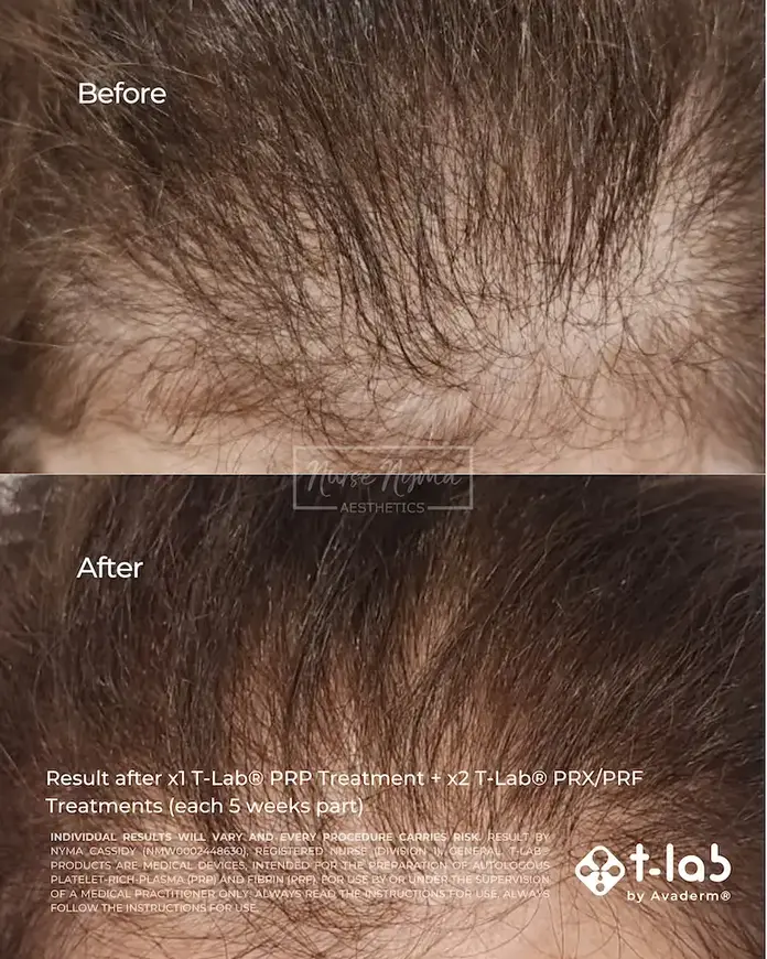 before and after showing increased hair density on the scalp from PRP and PRF treatment