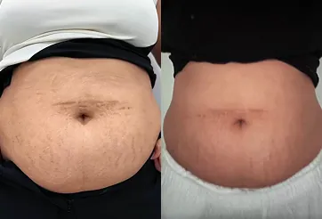 Before and after comparison of the abdomen area, showing a visible reduction in stretch marks and improved skin tightness through personalized treatments.