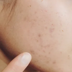 Close-up of flat, pigmented marks on the skin, illustrating post-inflammatory hyperpigmentation (PIH) and redness (PIE) after a breakout.