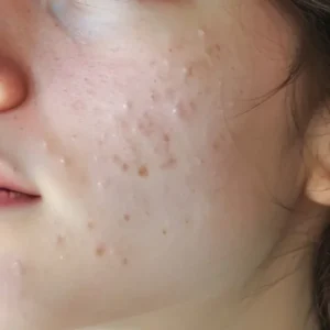 Close-up showing the depth of acne scars on the cheek, representing skin concerns that originate in the deeper dermis layer.