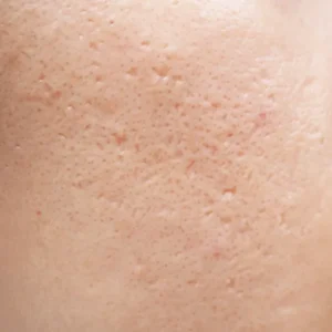 Close-up of skin texture showing atrophic acne scarring, characterized by small, indented pits or depressions on the cheek.