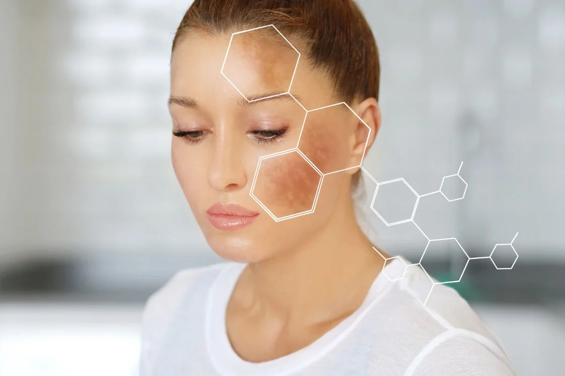 Woman with hyperpigmentation on her cheek and forehead, a concern chemical peels for hyperpigmentation can treat