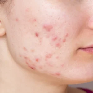 A close-up view of hypertrophic scarring on the face, appearing as raised, thickened areas of skin tissue.