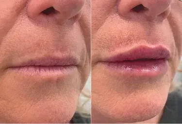 Before and after comparison of subtle lip enhancement treatment in Melbourne