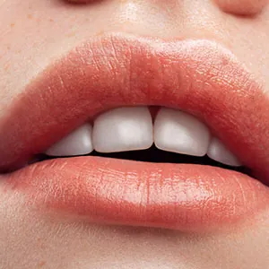 lip enhancement results from Luxe Lips